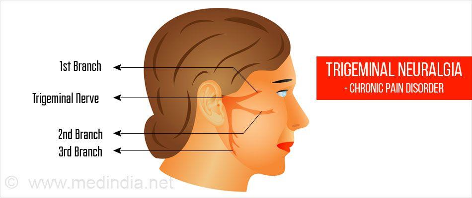Neurological facial pain
