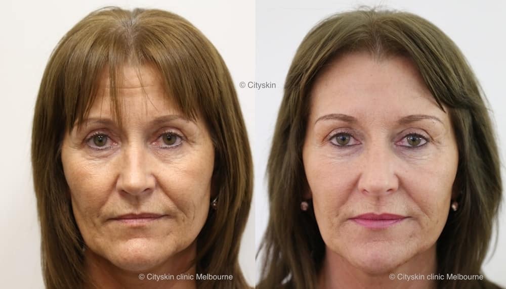 Facial injections for rejuvination