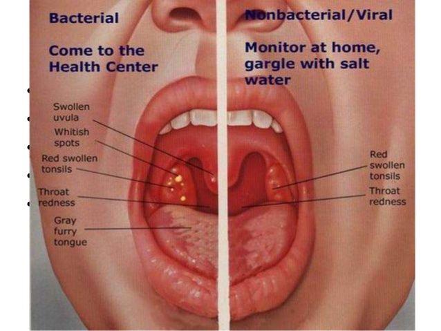 best of And adenoids Adult sore throat