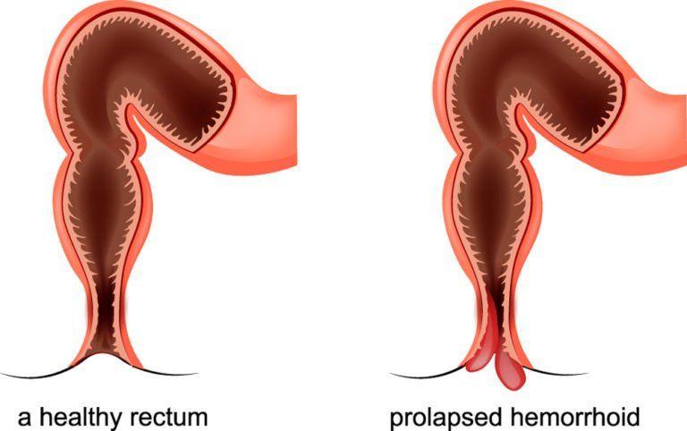 best of Protrusion Hernia anal