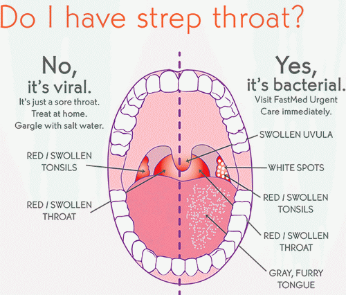 Daisy reccomend Signs of strep throat and adult