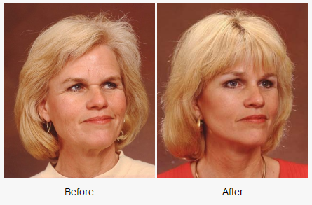 best of Procedures sonoma Facial