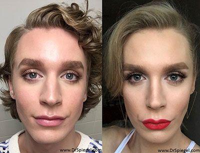 Earnie reccomend After before facial feminization surgery