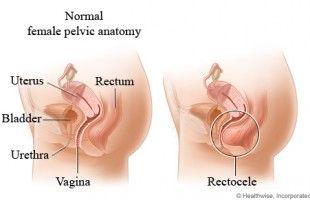 best of Protrusion Hernia anal