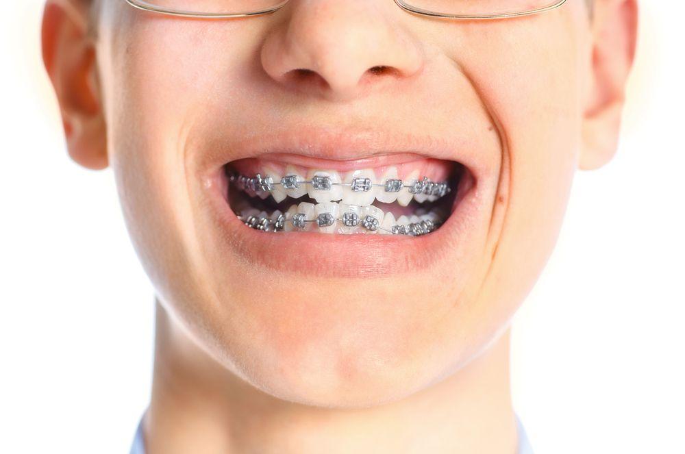 Getting braces as an adult