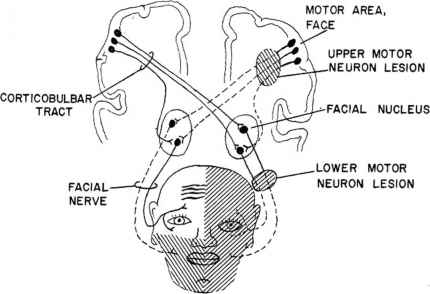 Facial nerve intervation