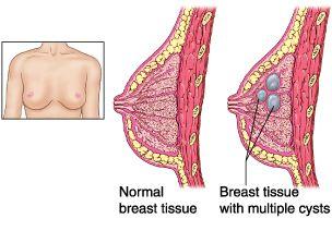 best of Breast Causes of fibrocystic
