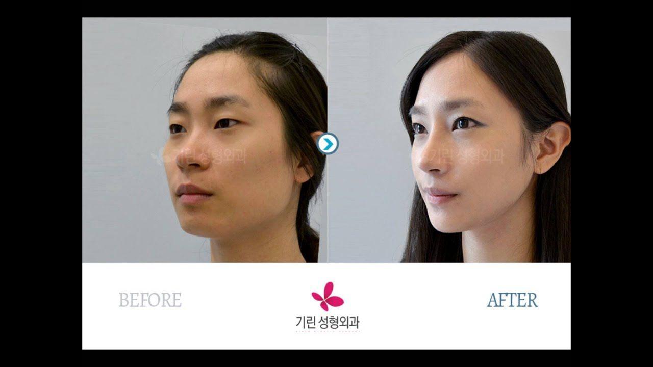Facial contour surgery