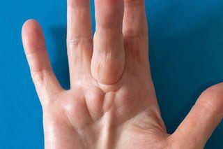 Lunar reccomend Pain in thumb and palm of hand unknown etiology
