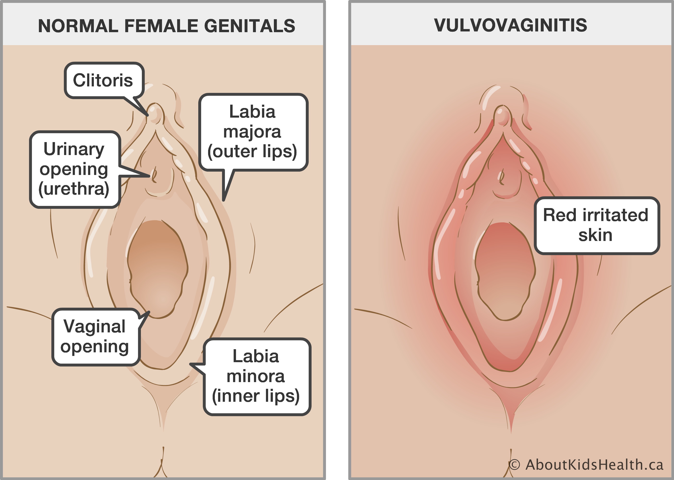 Sore vagina sore skin sore throat
