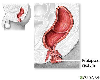 Hernia anal protrusion