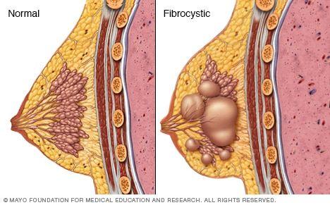 Watson reccomend Causes of fibrocystic breast