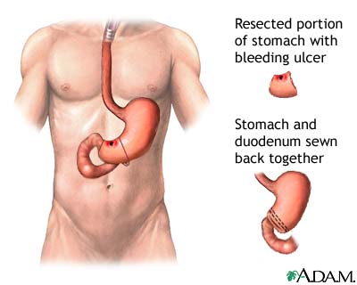 Anal bleeding with stomach pain