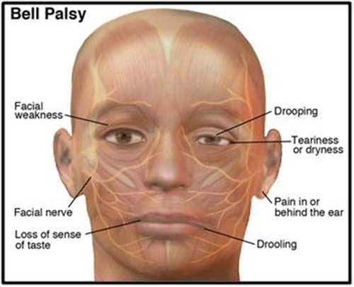 Facial neuritis palsy