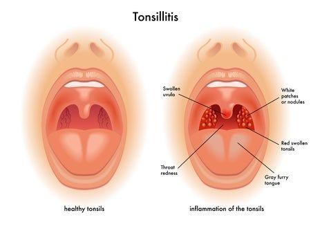 Adult sore throat and adenoids