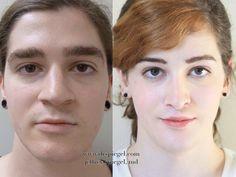 best of Feminization After surgery facial before