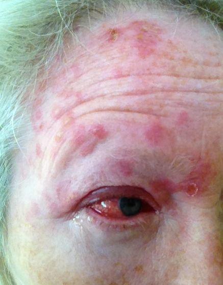 best of Eye facial the with shingles sensation Burning under
