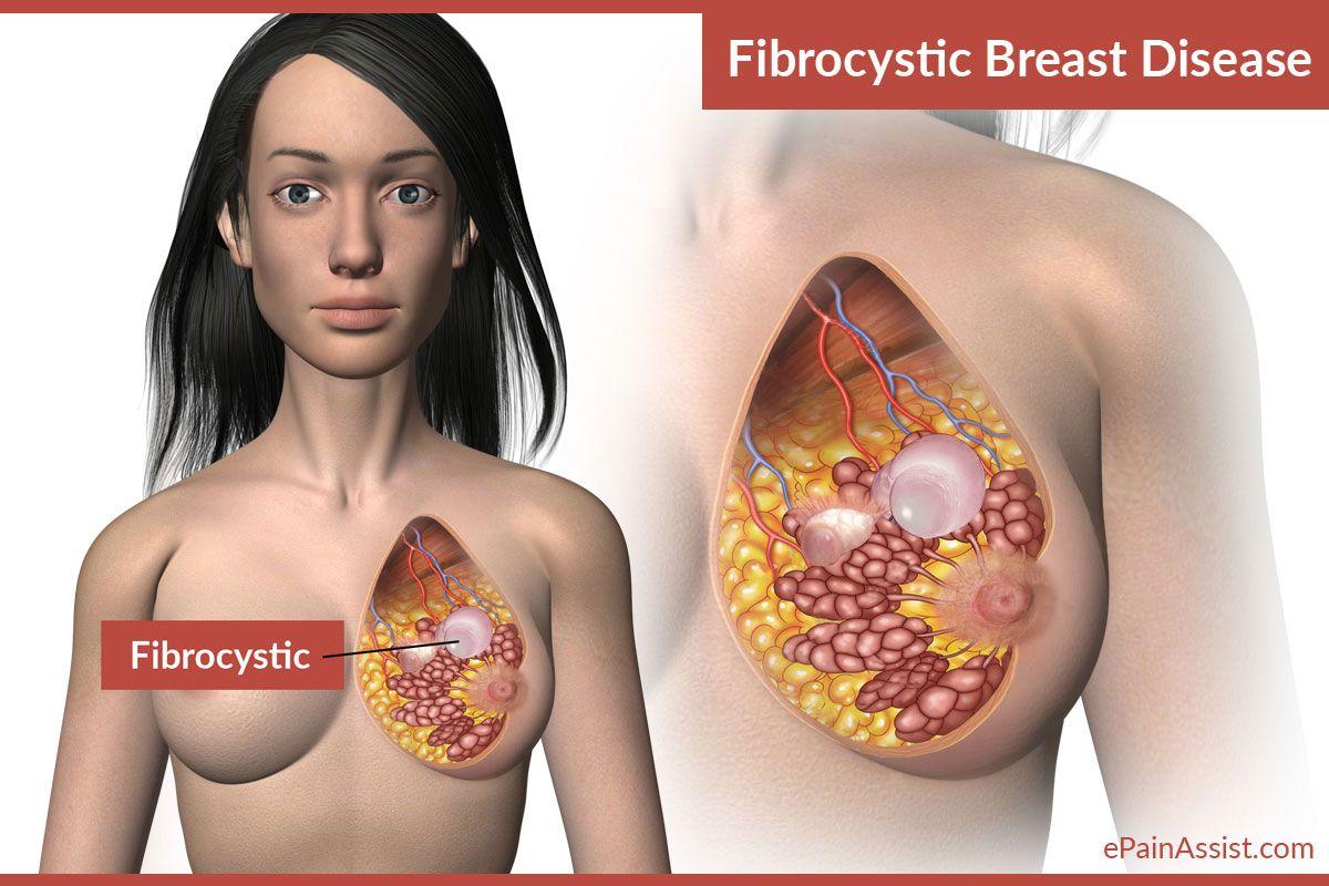 Causes of fibrocystic breast