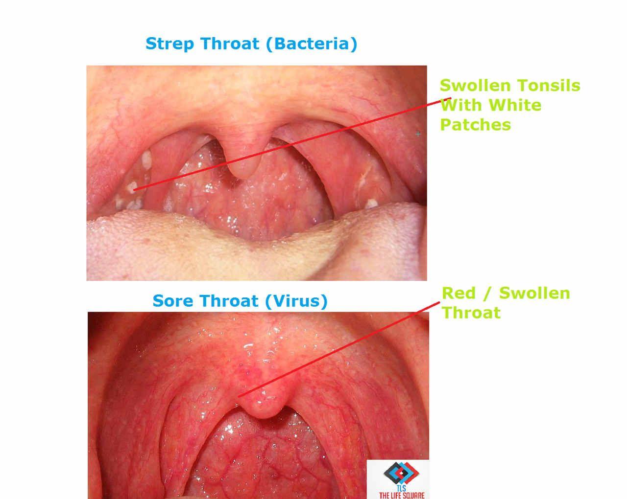 Signs of strep throat and adult