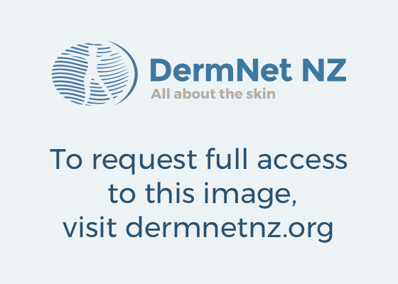 best of Dermatitis perioral Facial cleanser