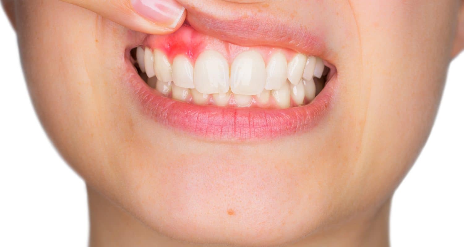 best of Facial Tooth abscess