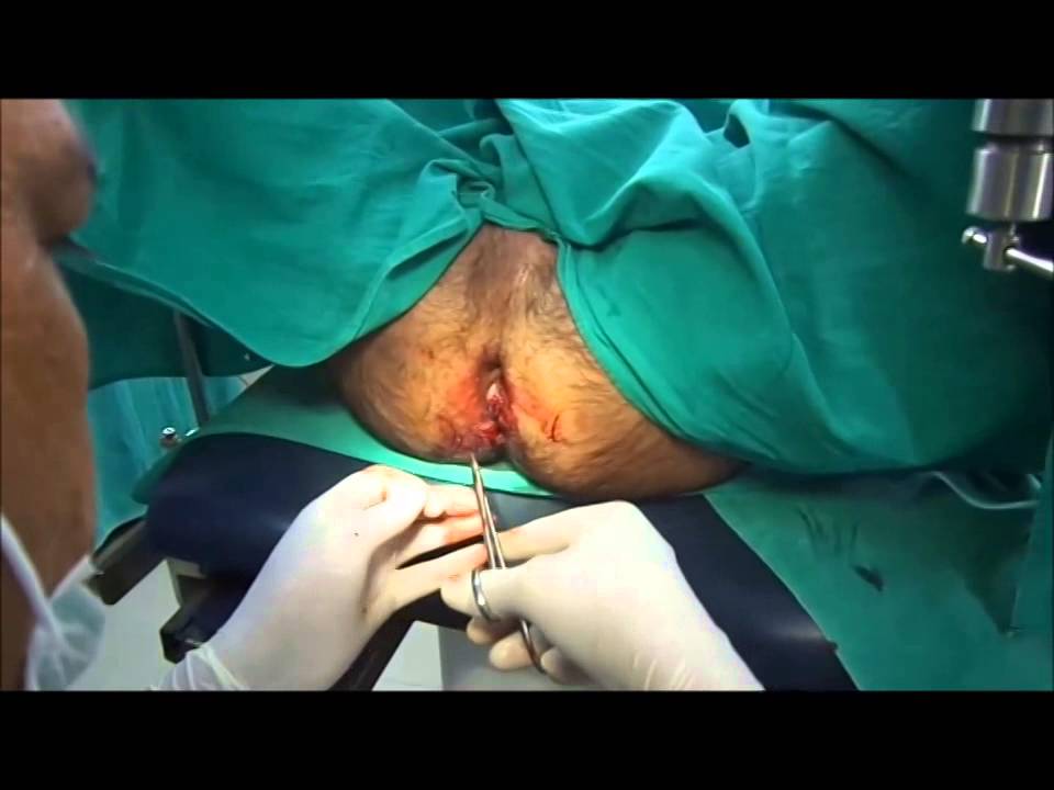 Spike reccomend Hernia anal protrusion