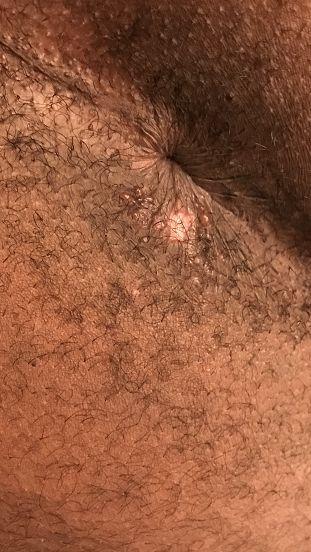 Hedgehog reccomend Painful bumps around anus
