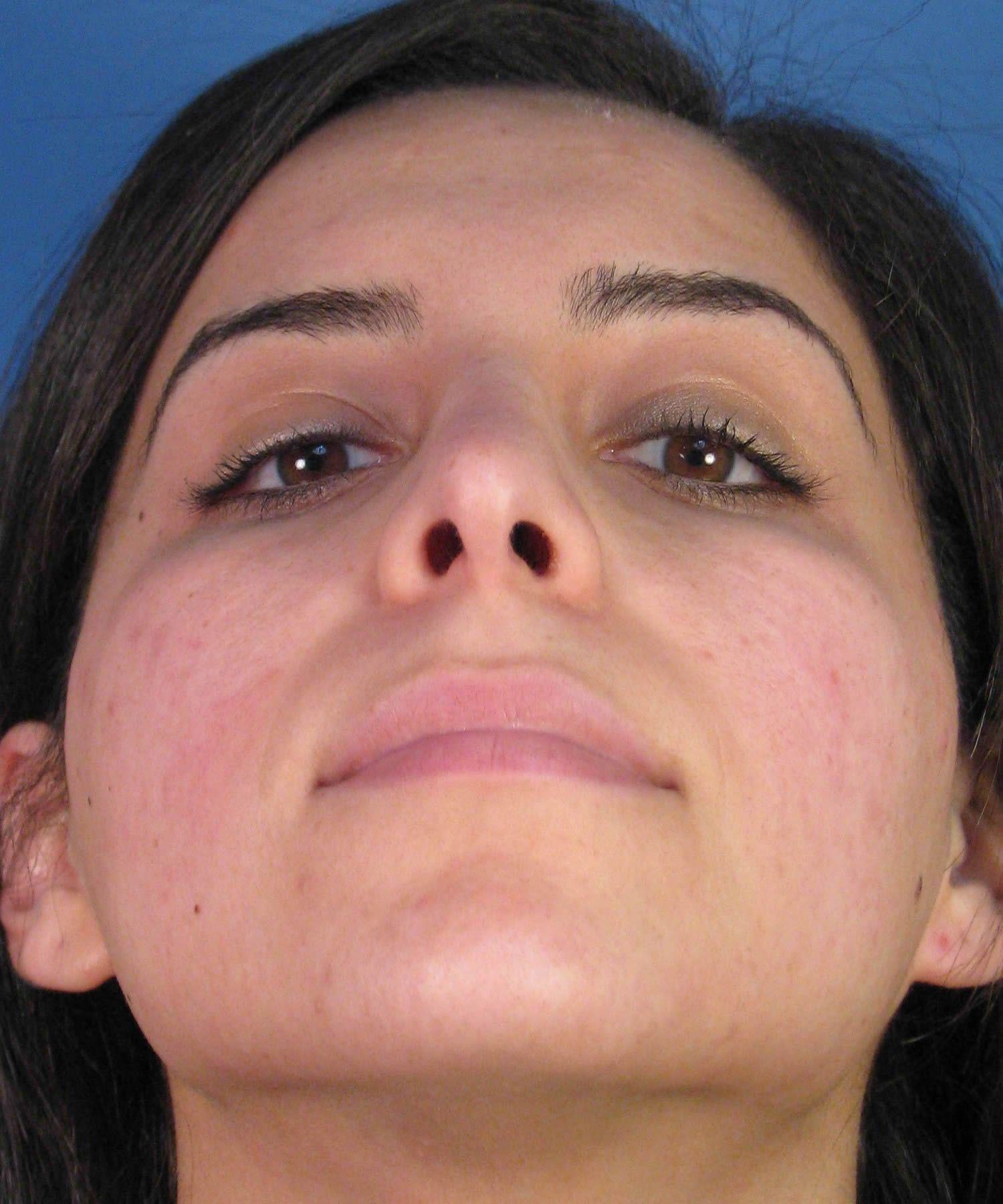 Radar reccomend Settlement facial scar bridge of nose