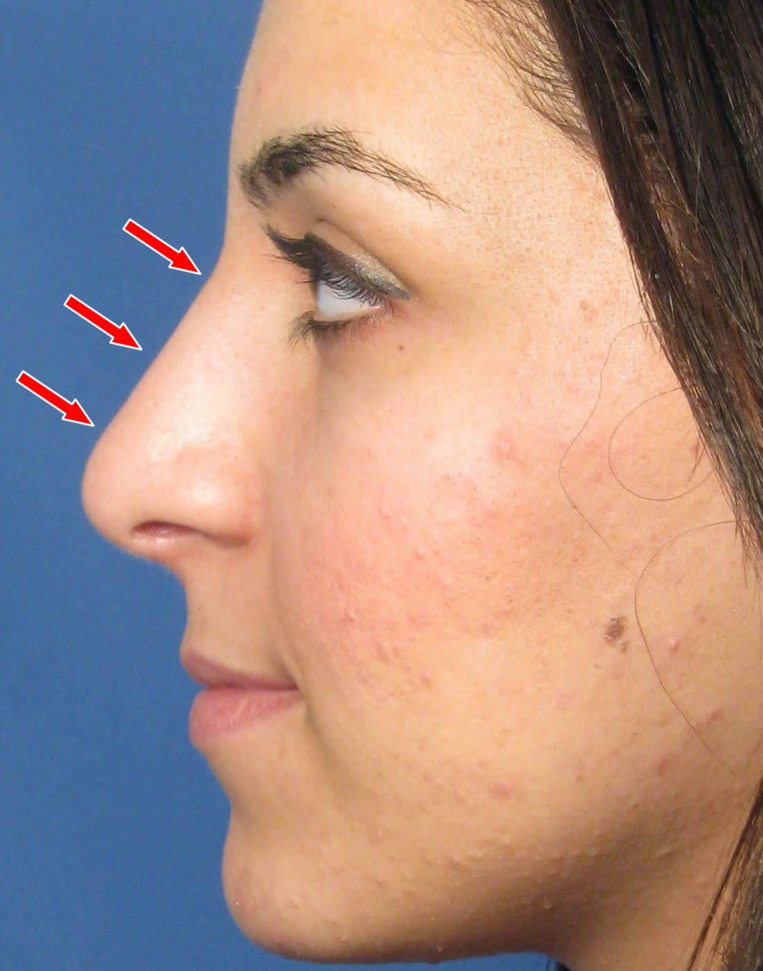 Settlement facial scar bridge of nose