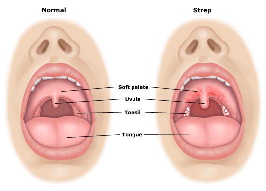 Bullpen reccomend Signs of strep throat and adult