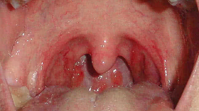 best of Throat strep adult of Signs and