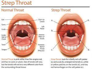 best of Throat strep adult of Signs and