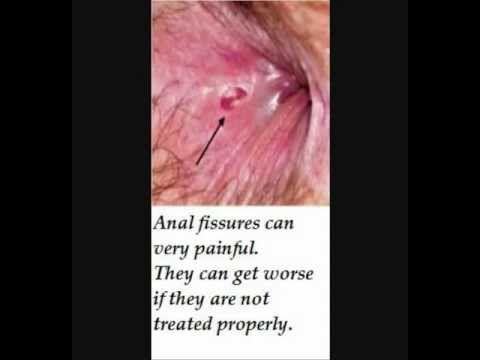 best of Painful raw skin and anus Sore